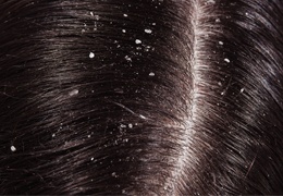 Pellicule cheveux: Causes, symptômes et remèdes